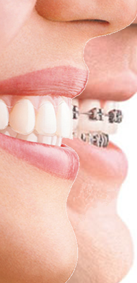 Ortodonti Diş tedavisi