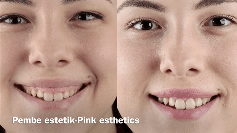 Pembe Estetik